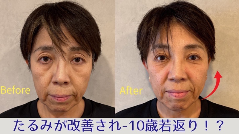 頬のたるみでお悩みのビフォーアフター画像
