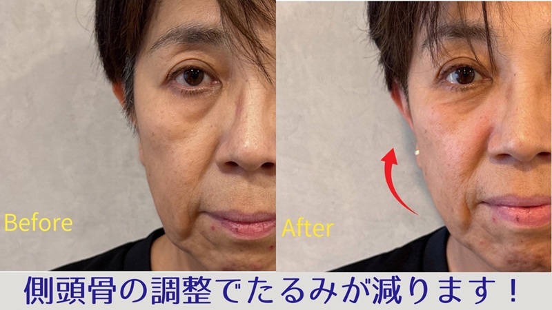 頬のたるみでお悩みのビフォーアフター画像(アップ)