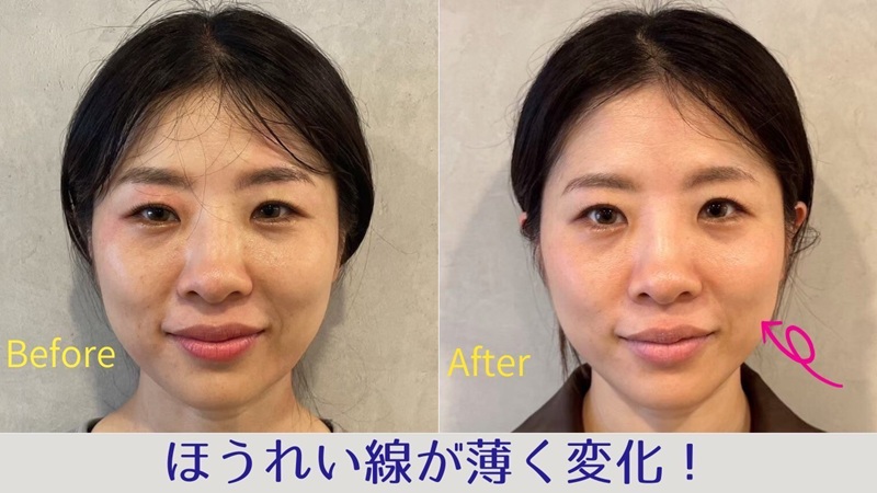 ほうれい線でお悩みのビフォーアフター画像