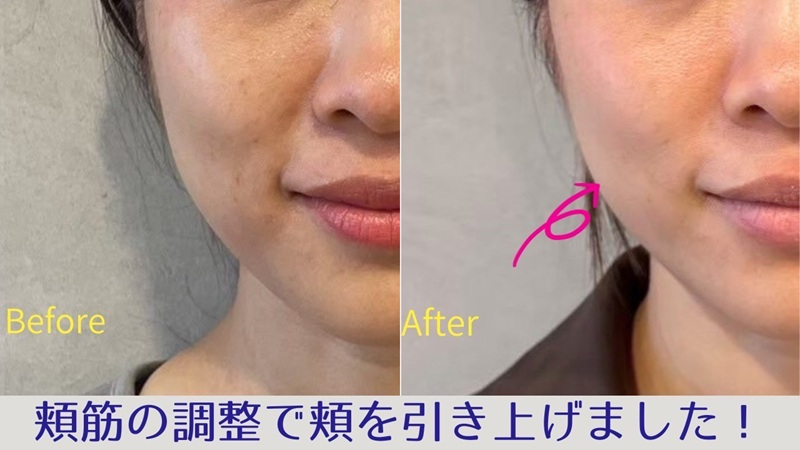 ほうれい線でお悩みのビフォーアフター画像(アップ)