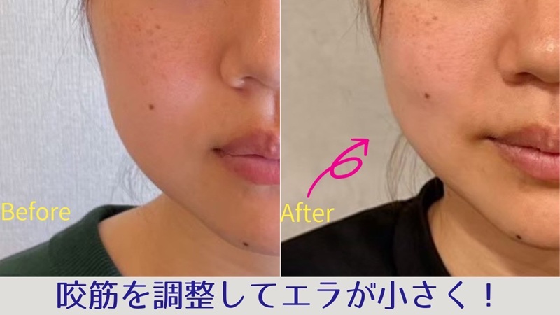エラ張りでお悩みのビフォーアフター画像(アップ)