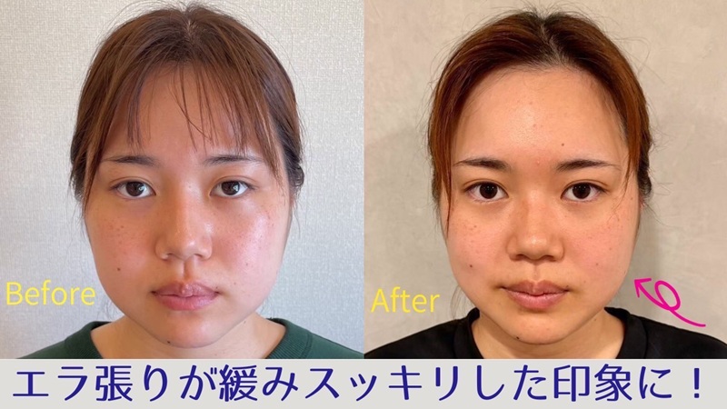 エラ張りでお悩みのビフォーアフター画像