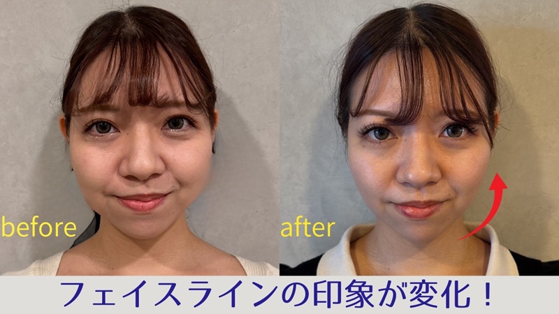 フェイスラインでお悩みのビフォーアフター画像