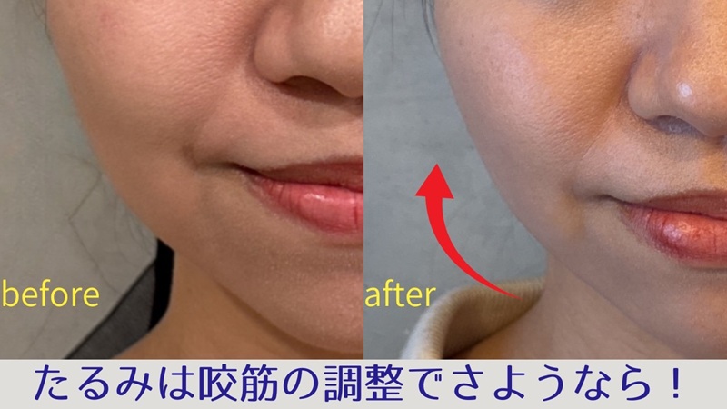 フェイスラインでお悩みのビフォーアフター画像(アップ)